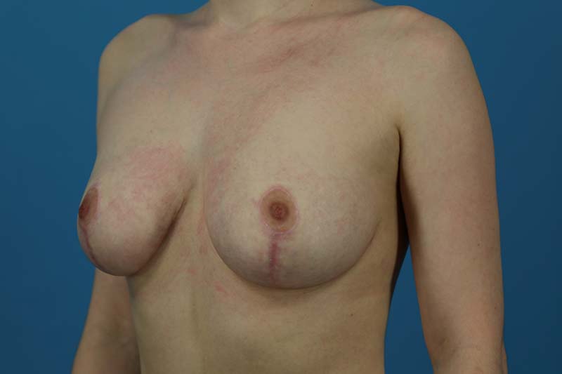 Breast Reduction Before and After | Dr Evan W Beale
