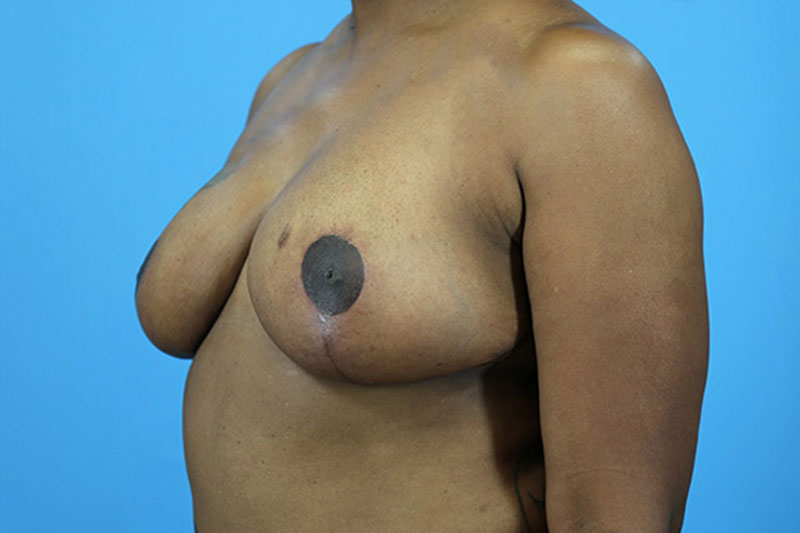 Breast Reduction Before and After | Dr Evan W Beale