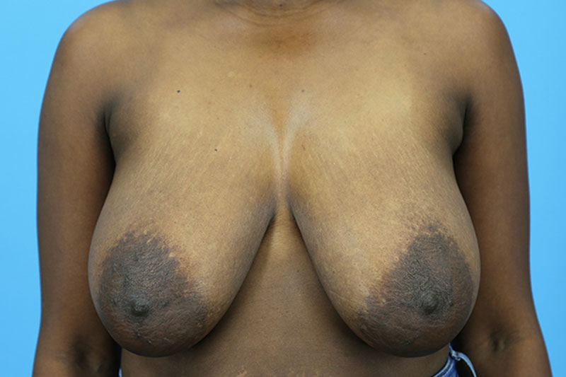 Breast Reduction Before and After | Dr Evan W Beale