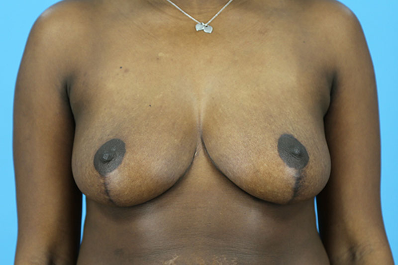 Breast Reduction Before and After | Dr Evan W Beale