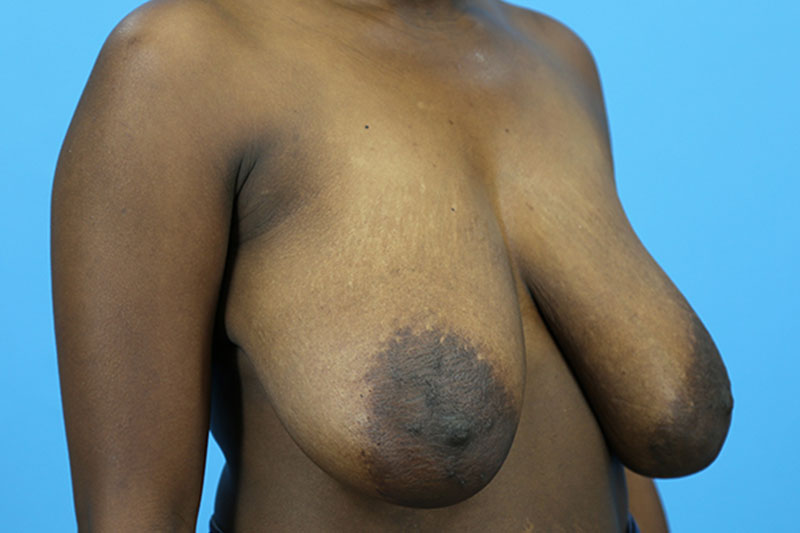 Breast Reduction Before and After | Dr Evan W Beale