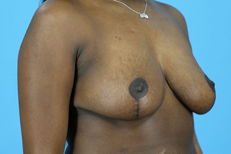 Breast Reduction Before and After | Dr Evan W Beale