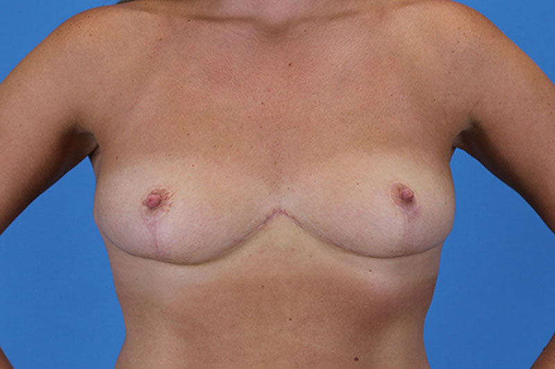 Breast Reduction Before and After | Dr Evan W Beale