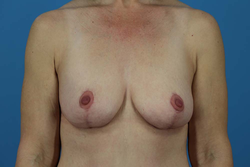 Mastopexy Before and After | Dr Evan W Beale