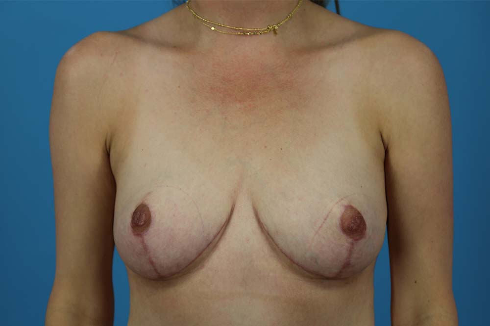 Mastopexy Before and After | Dr Evan W Beale