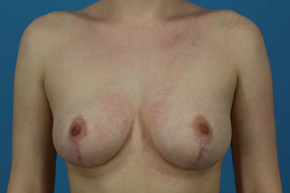 Mastopexy Before and After | Dr Evan W Beale