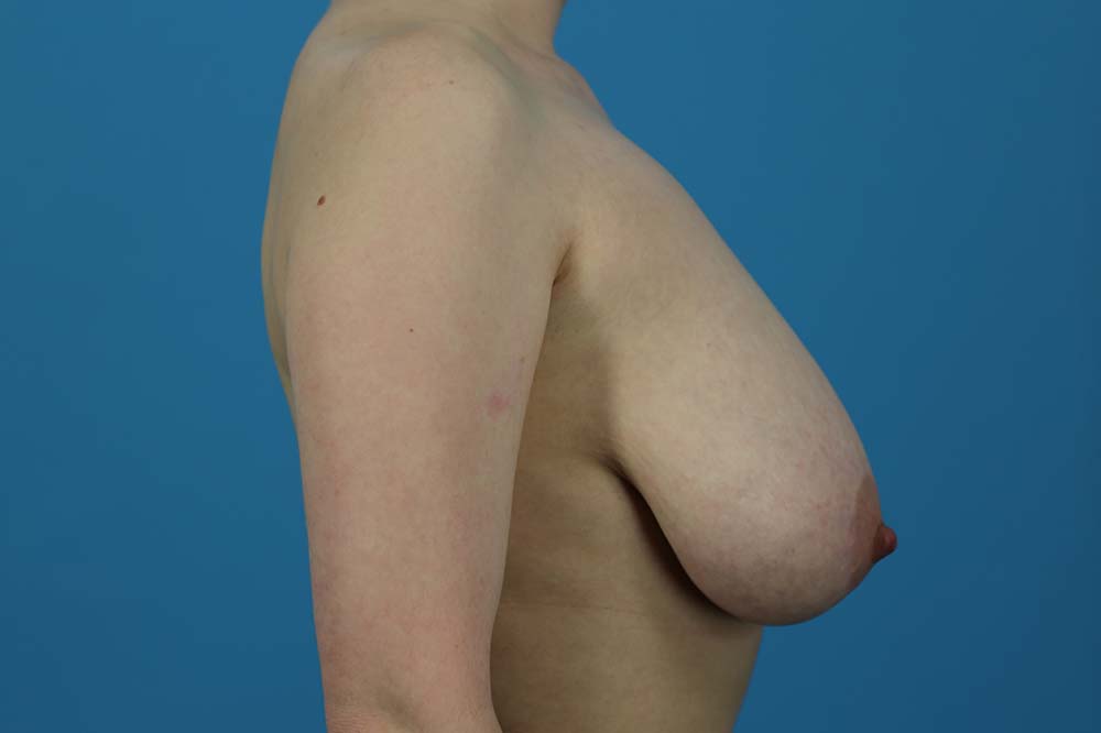 Mastopexy Before and After | Dr Evan W Beale