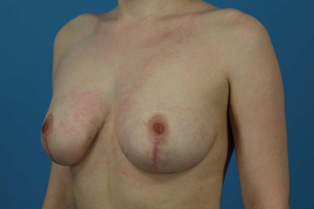 Mastopexy Before and After | Dr Evan W Beale