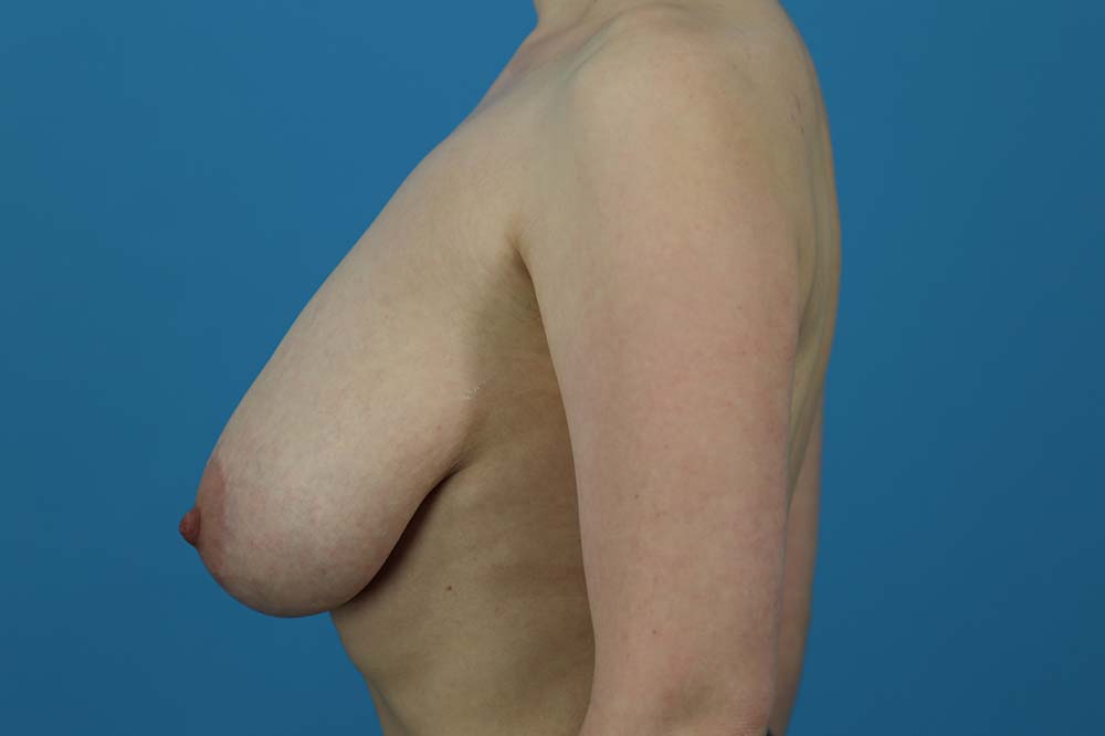 Mastopexy Before and After | Dr Evan W Beale