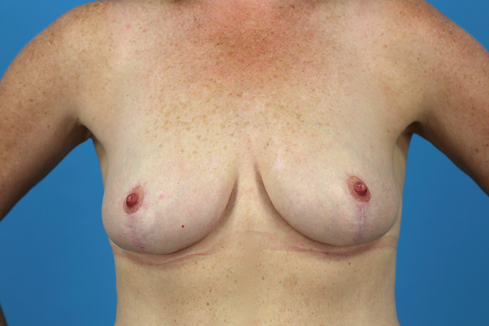 Mastopexy Before and After | Dr Evan W Beale