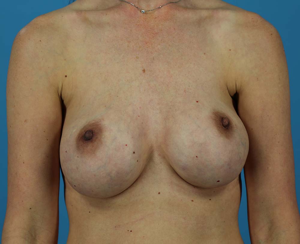 Secondary Breast Surgery Before and After | Dr Evan W Beale