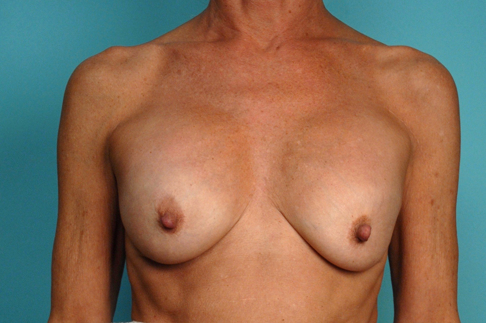 Secondary Breast Surgery Before and After | Dr Evan W Beale