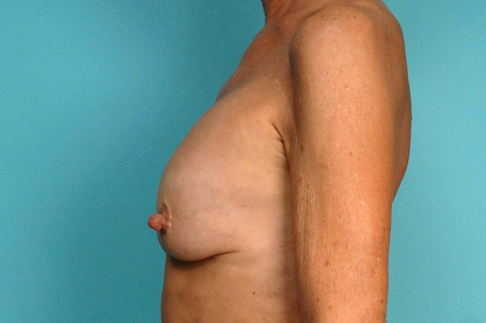 Secondary Breast Surgery Before and After | Dr Evan W Beale