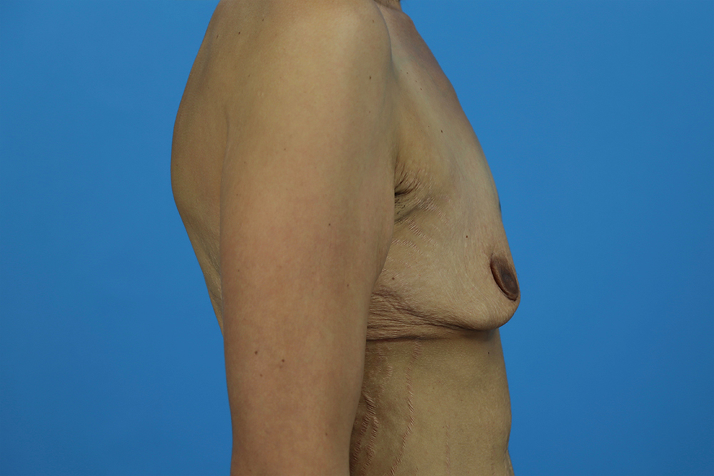 Secondary Breast Surgery Before and After | Dr Evan W Beale