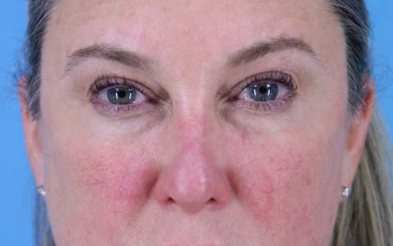 Blepharoplasty Before and After | Dr Evan W Beale