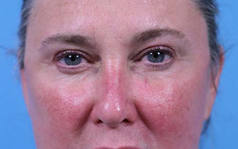 Blepharoplasty Before and After | Dr Evan W Beale
