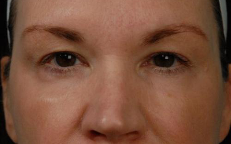 Blepharoplasty Before and After | Dr Evan W Beale