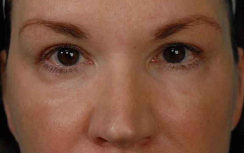 Blepharoplasty Before and After | Dr Evan W Beale