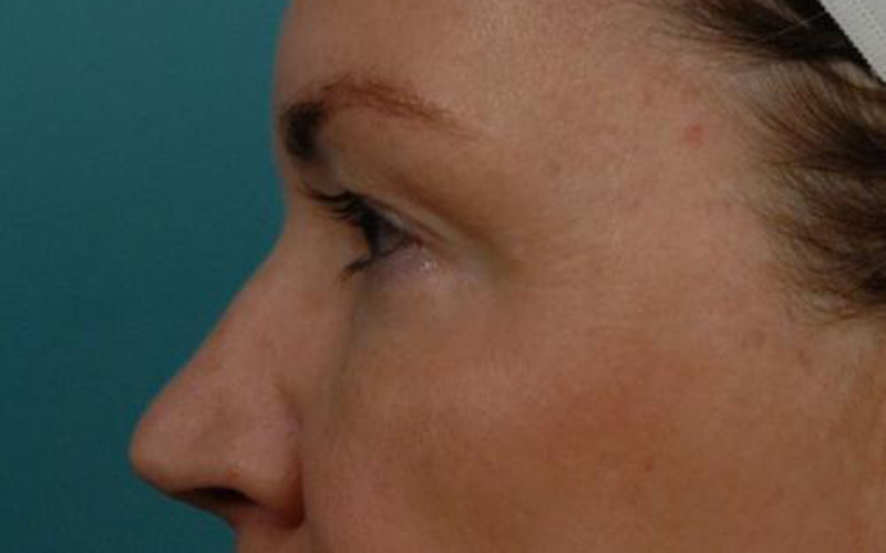 Blepharoplasty Before and After | Dr Evan W Beale