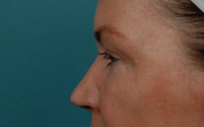 Blepharoplasty Before and After | Dr Evan W Beale