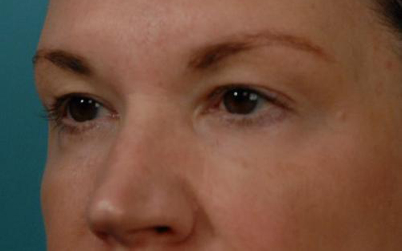 Blepharoplasty Before and After | Dr Evan W Beale