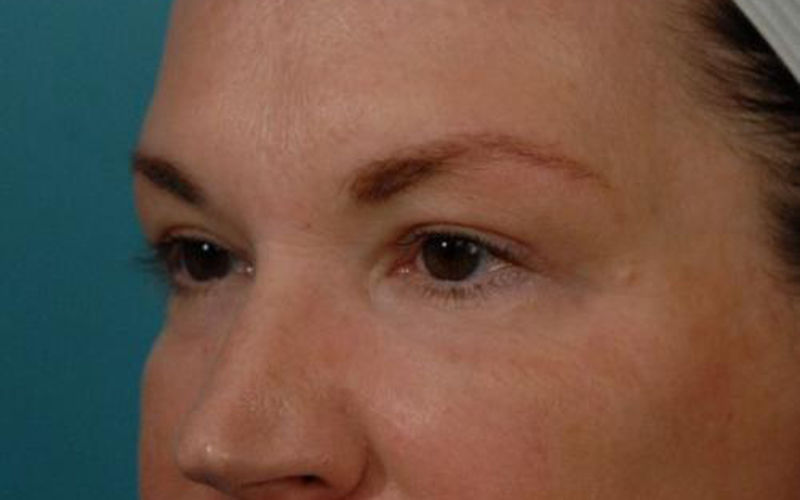 Blepharoplasty Before and After | Dr Evan W Beale