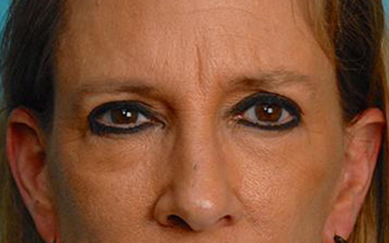 Blepharoplasty Before and After | Dr Evan W Beale
