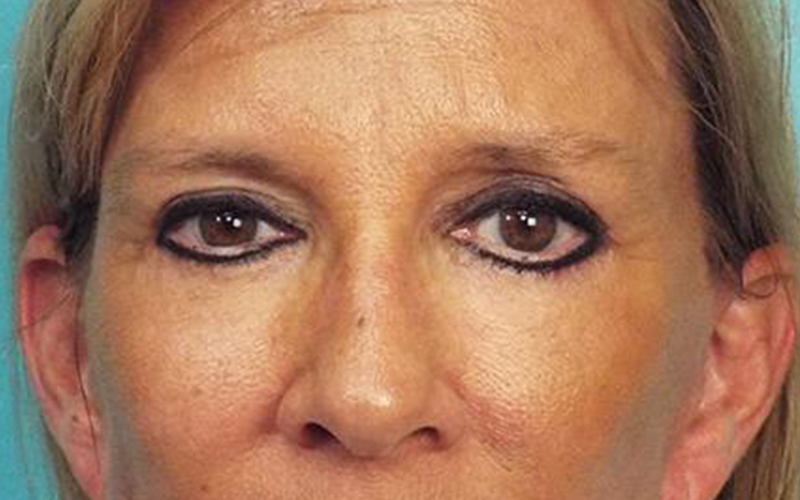 Blepharoplasty Before and After | Dr Evan W Beale