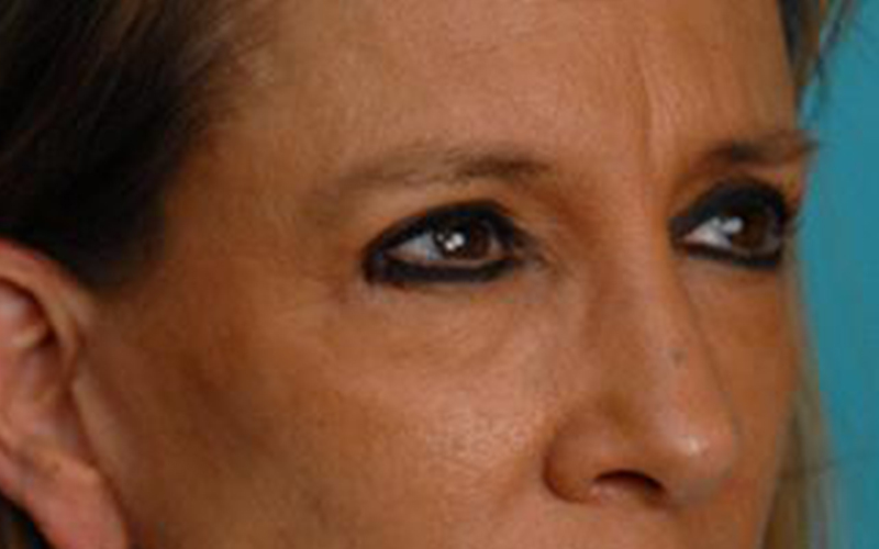 Blepharoplasty Before and After | Dr Evan W Beale