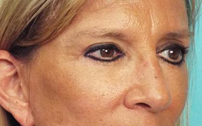 Blepharoplasty Before and After | Dr Evan W Beale