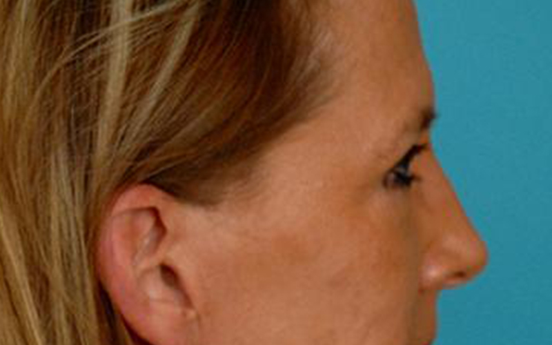 Blepharoplasty Before and After | Dr Evan W Beale