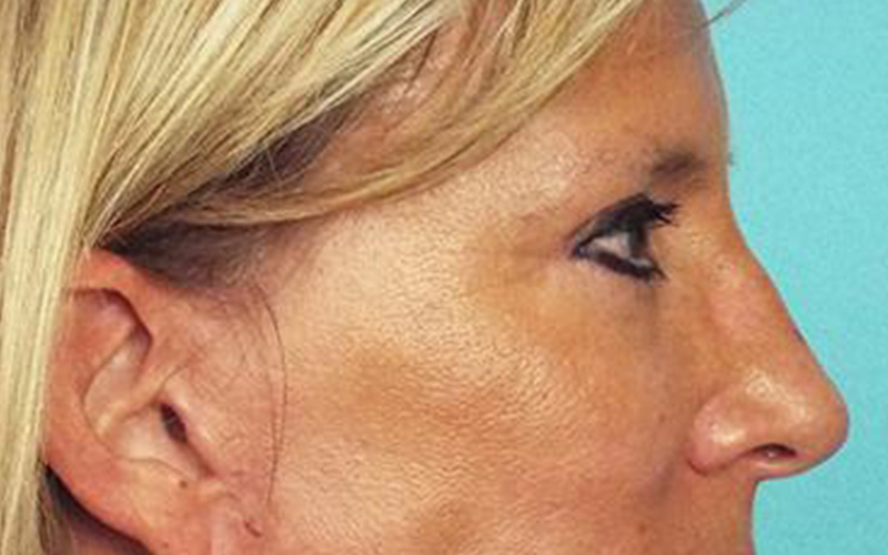 Blepharoplasty Before and After | Dr Evan W Beale