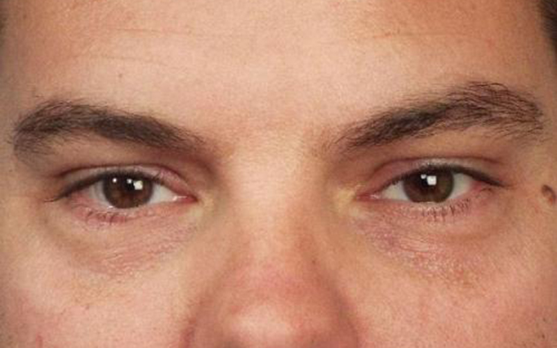 Blepharoplasty Before and After | Dr Evan W Beale