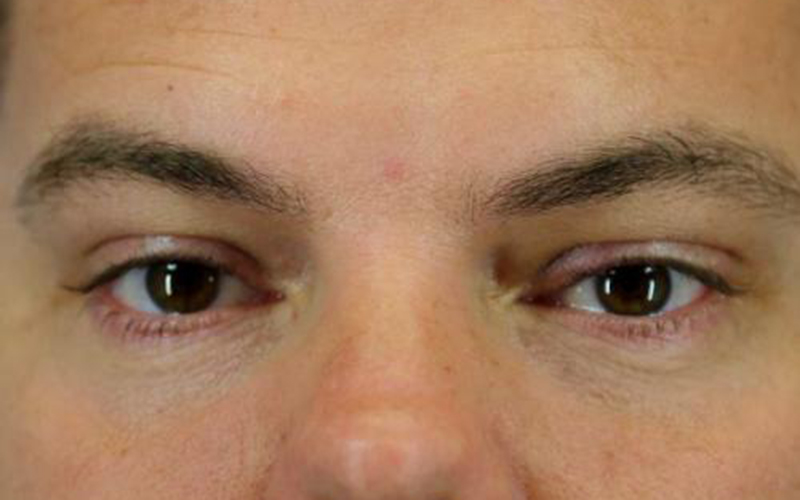 Blepharoplasty Before and After | Dr Evan W Beale
