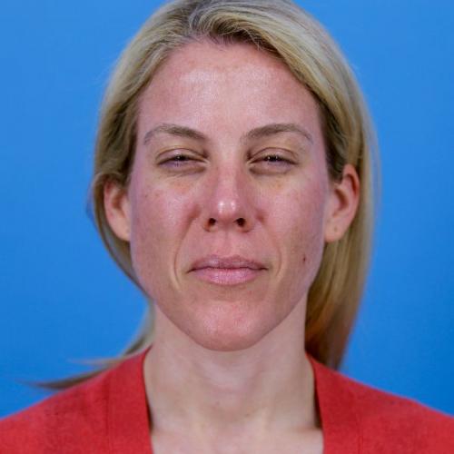 Botox Before and After | Dr Evan W Beale