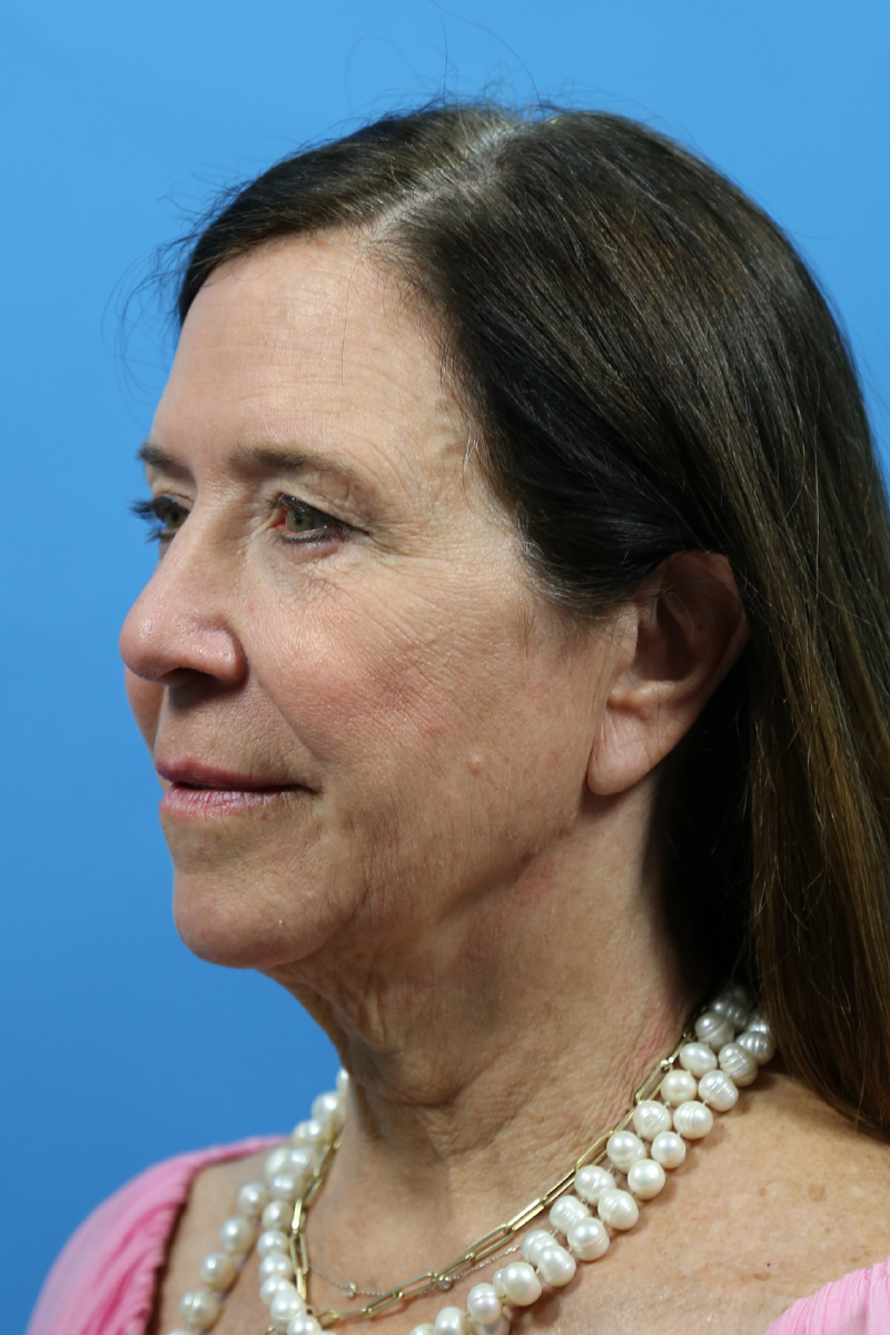 Facelift Before and After | Dr Evan W Beale