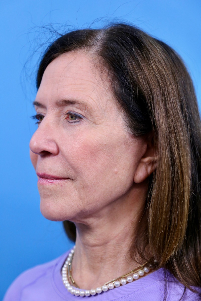 Facelift Before and After | Dr Evan W Beale