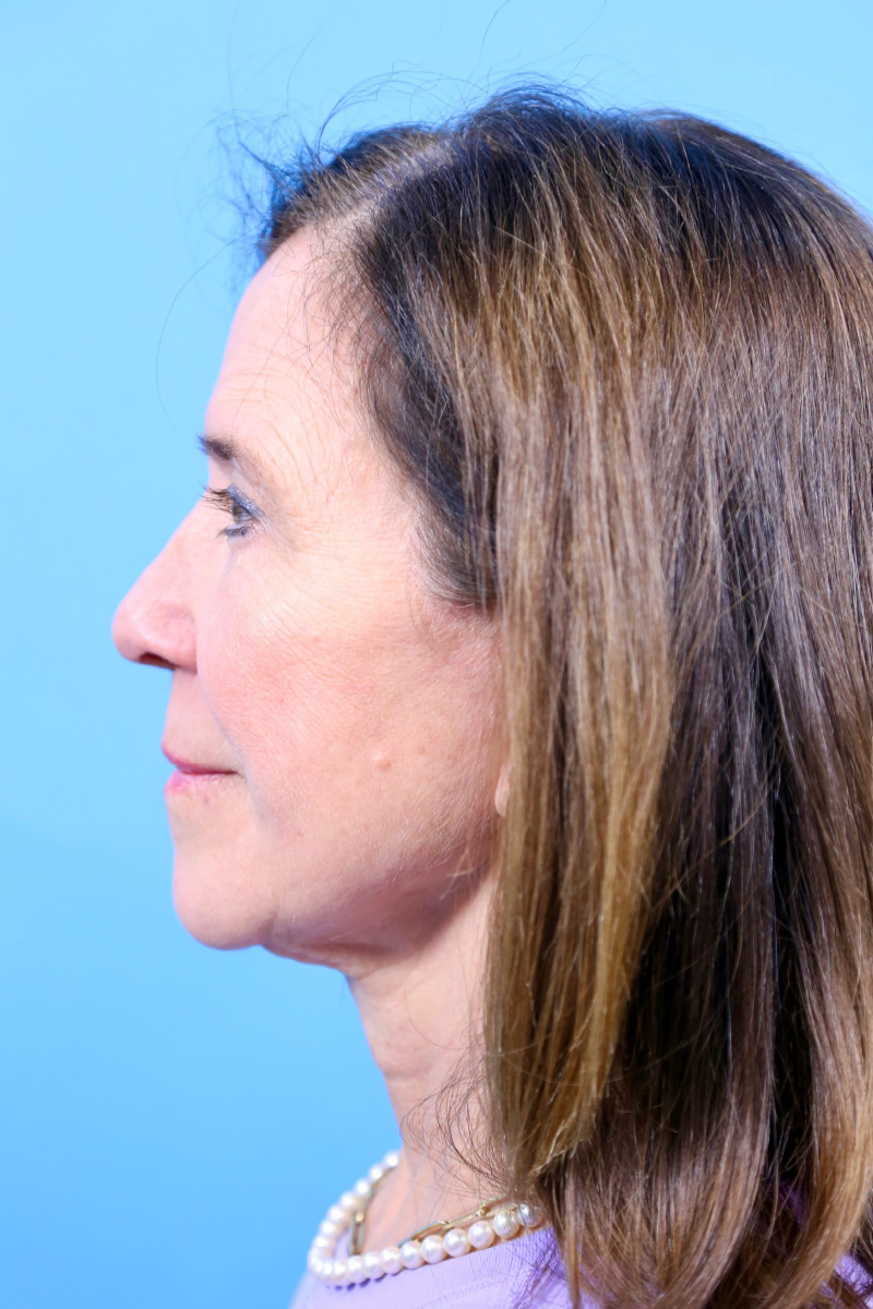 Facelift Before and After | Dr Evan W Beale