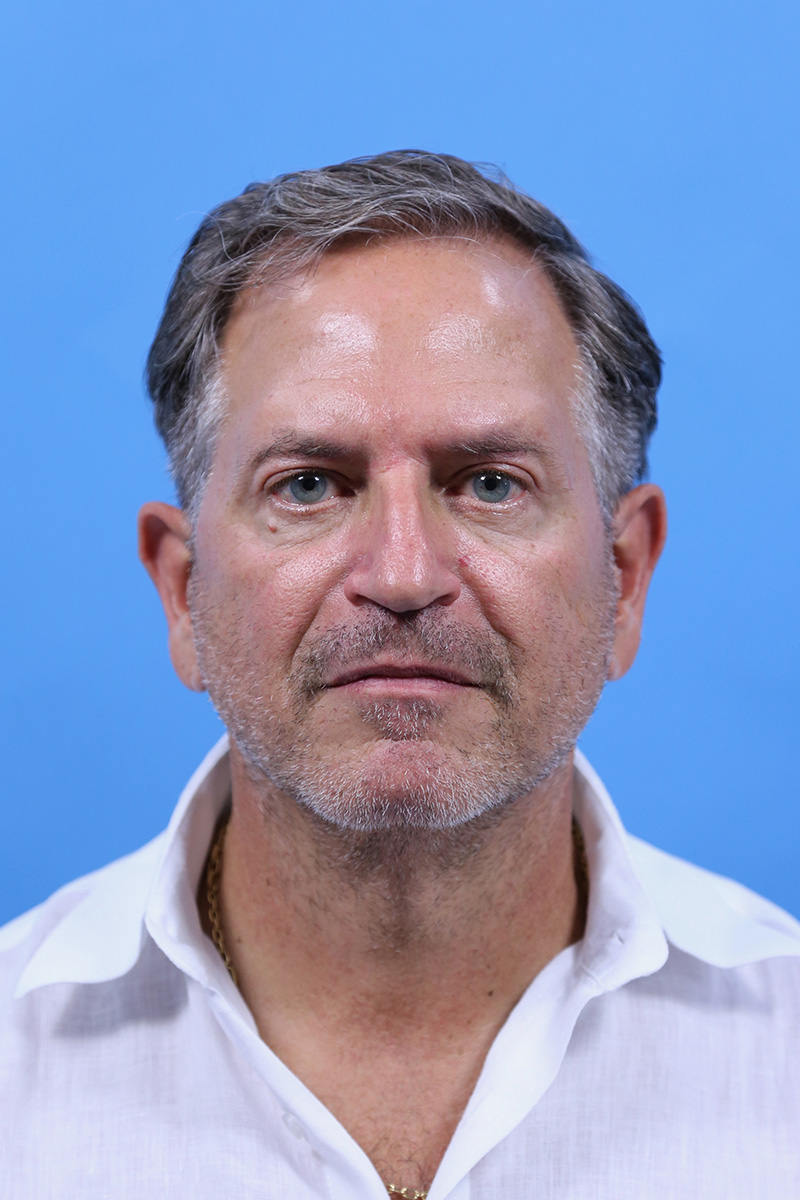 Facelift Before and After | Dr Evan W Beale