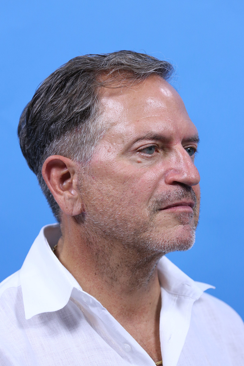 Facelift Before and After | Dr Evan W Beale