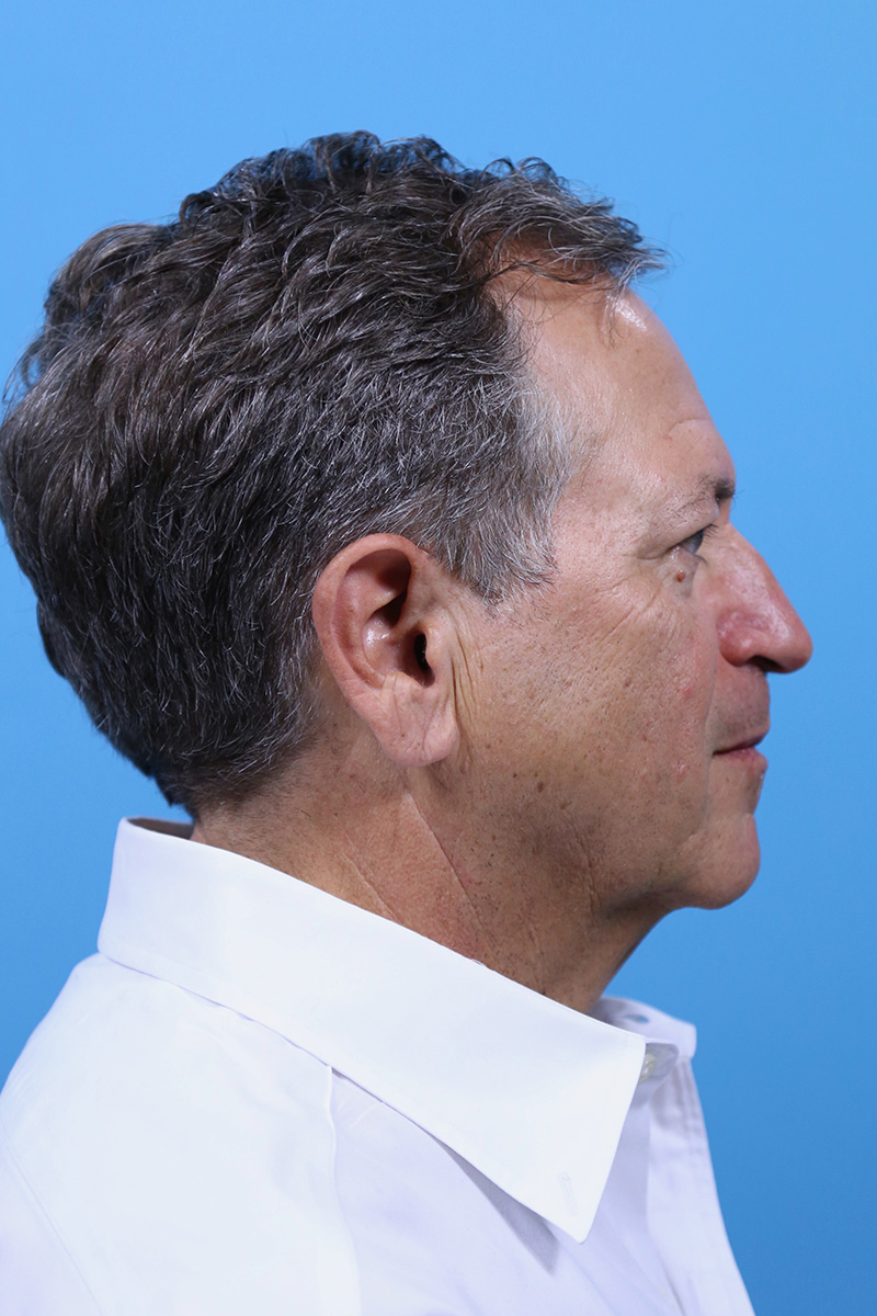 Facelift Before and After | Dr Evan W Beale