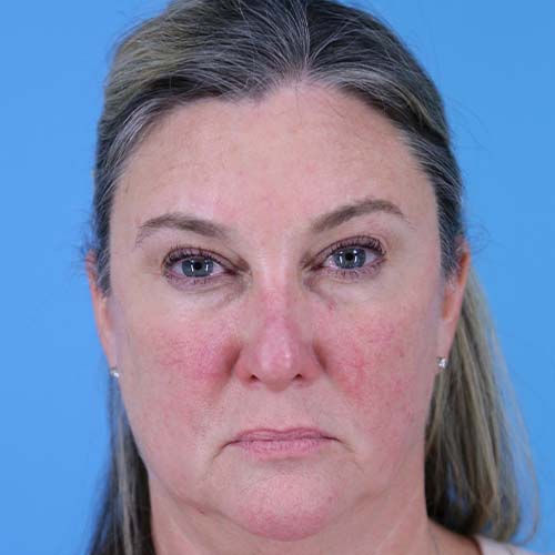 Facelift Before and After | Dr Evan W Beale