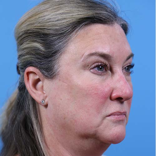 Facelift Before and After | Dr Evan W Beale