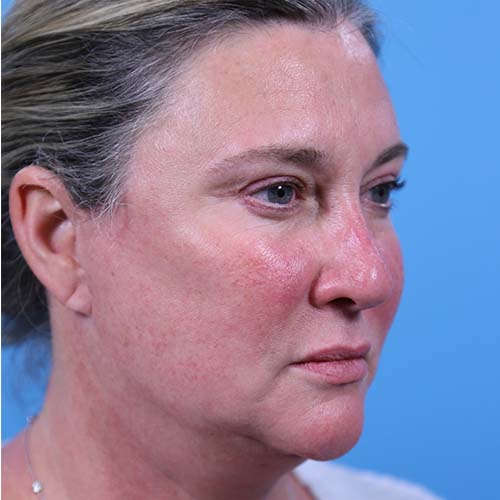 Facelift Before and After | Dr Evan W Beale