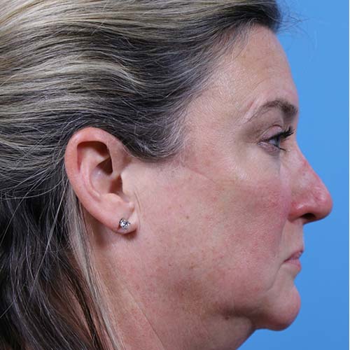 Facelift Before and After | Dr Evan W Beale