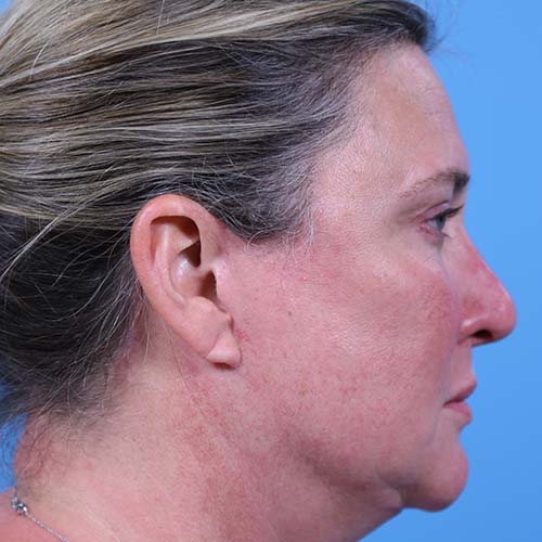 Facelift Before and After | Dr Evan W Beale