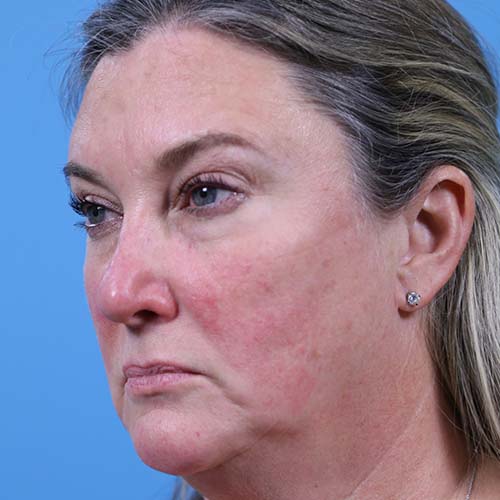 Facelift Before and After | Dr Evan W Beale
