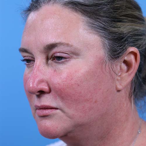 Facelift Before and After | Dr Evan W Beale