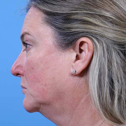 Facelift Before and After | Dr Evan W Beale