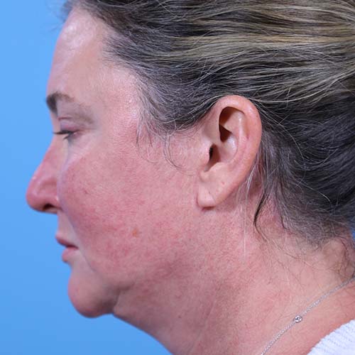 Facelift Before and After | Dr Evan W Beale